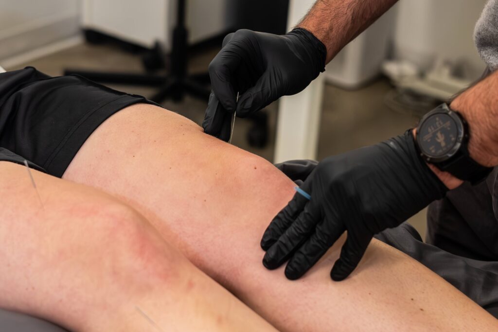 Close-up of an acupuncture needle being placed in the quadricep muscle above a patient's knee.