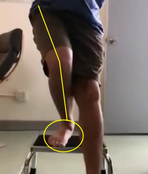   Knee valgus position:  Note the thigh adducting towards the inside, knee dropping inward, and a lack of space between the legs. Also notice that this causes a collapse of the medial longitudinal arch of the foot. Failure to control this position is associated with many lower extremity injuries. 